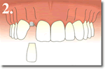Single Tooth Replacement - Step Two